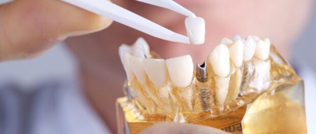 Dental Implants restoration in Houston