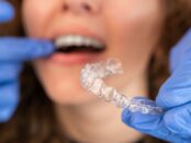 Orthodontics in crossroads dental of victoria