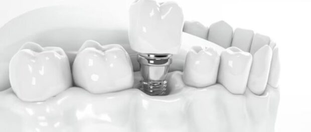 Dental Implants Artesia