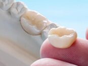 Dental Crowns in Saginaw