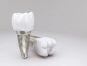 Dental Implant in Shelton