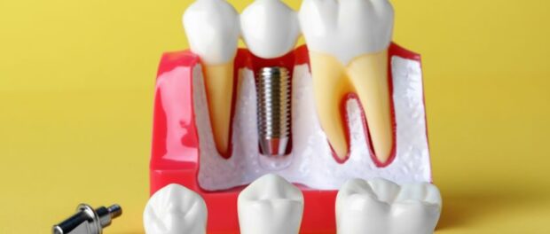 Dental Implants