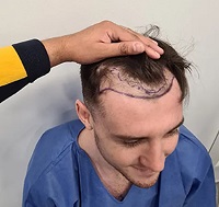 harley st hair transplant