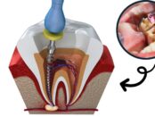 Root Canal treatment in Whitehouse