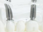 dental implants in El Paso
