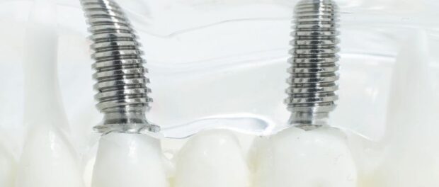 dental implants in El Paso
