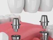 Full Dental Implants in Scottsdale