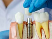 The Art of Dental Implants A Look into 7 North Dental's Expertise