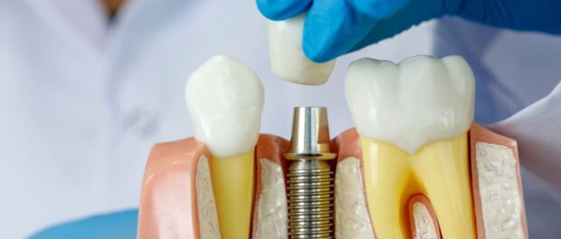 The Art of Dental Implants A Look into 7 North Dental's Expertise