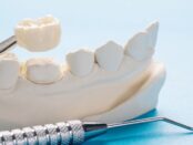 Dental Crowns in Ardmore