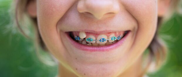 orthodontic treatment for kids in rowlett