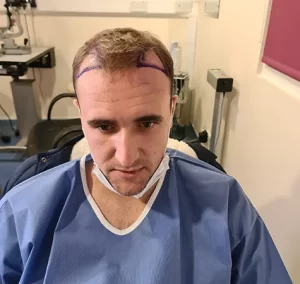 cheap hair transplant uk