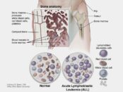 Acute Lymphoblastic Leukemia