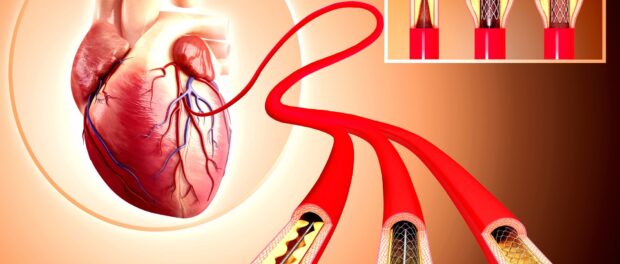 Arterial Stents