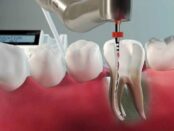 Dental Endodontics