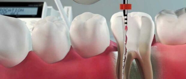 Dental Endodontics