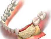 Dental Membrane and Bone Graft Substitutes