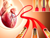 Global Coronary Stents Industry