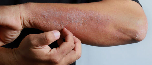 Radiodermatitis