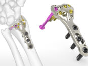 Small Bone and Joint Orthopedic Devices