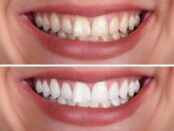 Teeth whitening at Crossroads dental of Victoria