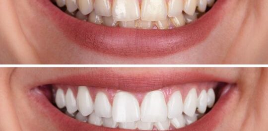 Teeth whitening at Crossroads dental of Victoria