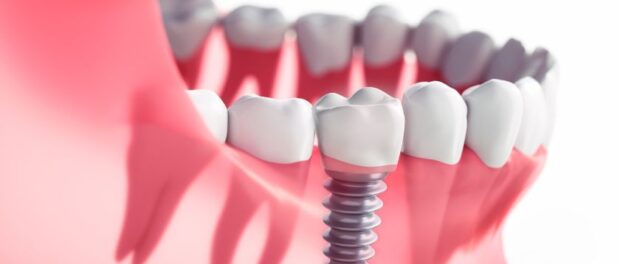 Dental Implants Beaverton