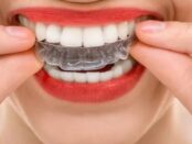 Invisalign El Paso - Cielo Dental & Orthodontics