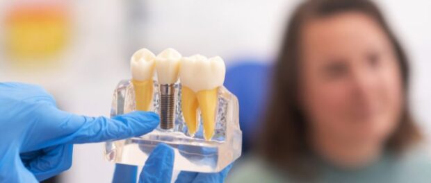 Dental Implant by Kelly Smile