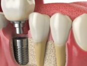 Dental Implants El Paso - Cielo Dental & Orthodontics