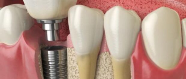 Dental Implants El Paso - Cielo Dental & Orthodontics