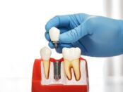 Dental Implants Seattle