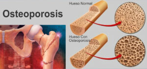 Global Postmenopausal Osteoporosis Treatment Industry