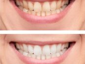 Teeth whitening Tempe at Our dental care Okun dentistry