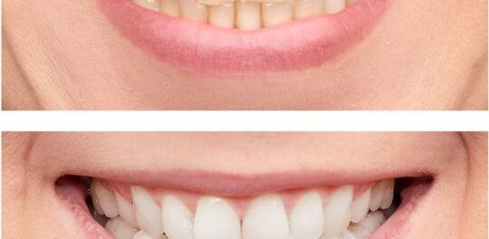 Teeth whitening Tempe at Our dental care Okun dentistry