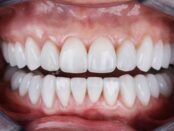 Teeth whitening at our dental care Crossroads dental Victoria