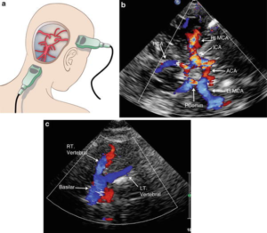 Transcranial Doppler Ultrasound System Market