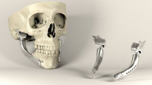 3D Printed Maxillofacial Implants