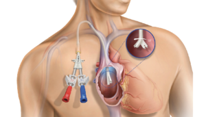 Global Catheter-Related Bloodstream Infection Treatment Industry