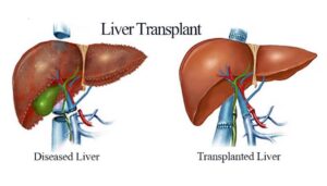 Liver Transplantation Market