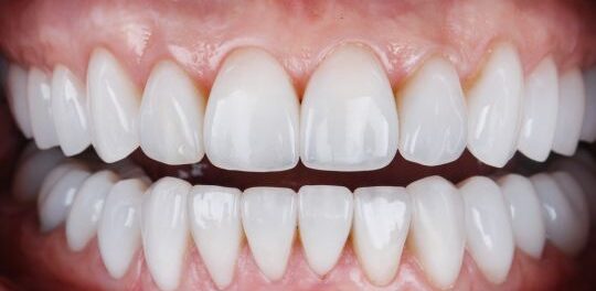 Teeth whitening in Victoria at Crossroads Dental of Victoria