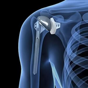 Humeral Implants