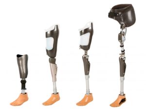 Motorized Prosthesis Market