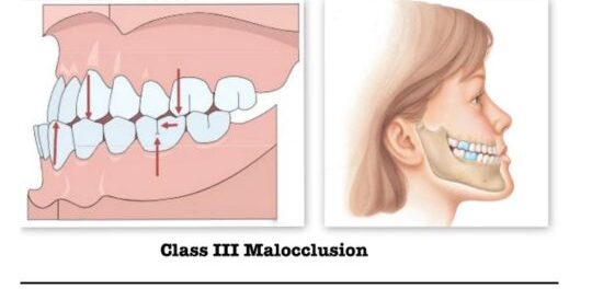 Consequences of Untreated Class 3 Malocclusion