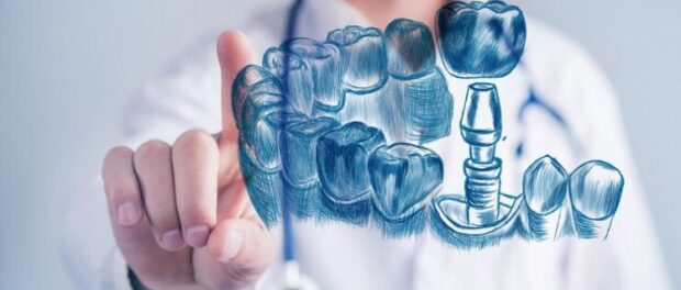 Dental Implant Solutions in Amarillo