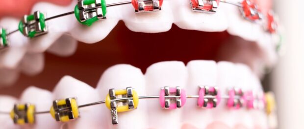 Metal Braces in Layton