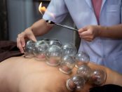 Cupping Therapy