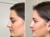 Non-Surgical Rhinoplasty