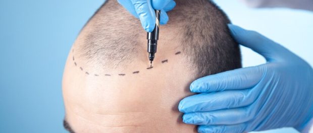 Best Hair Transplant