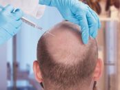 FUE hair transplant